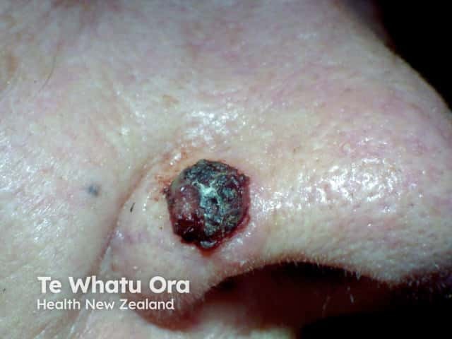 Pigmented basal cell carcinoma