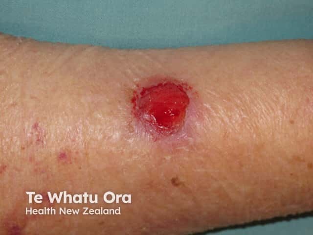 Basal cell carcinoma, arm