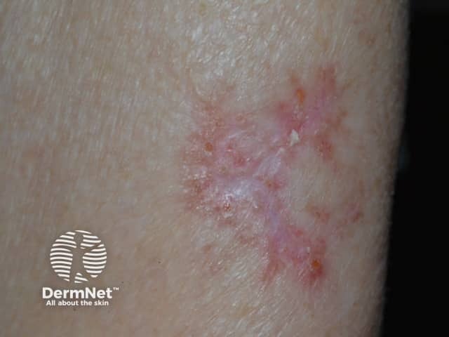 Basal cell carcinoma, arm