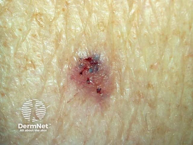 Basal cell carcinoma, arm