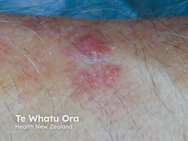 Basal cell carcinoma, arm