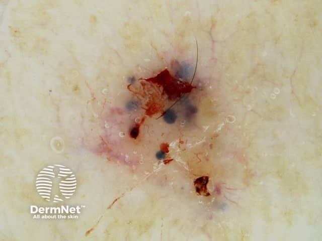 Blue-grey ovoid nests in pigmented basal cell carcinoma dermoscopy