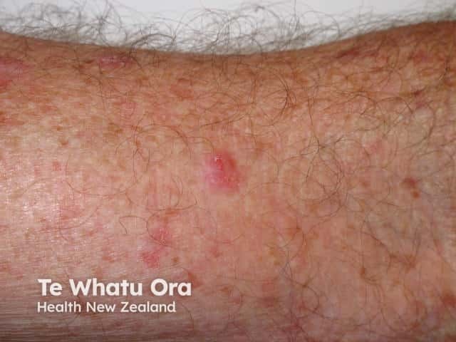 Basal cell carcinoma, arm