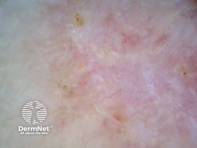 Basal cell carcinoma dermoscopy