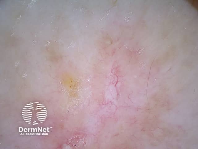 Basal cell carcinoma dermoscopy