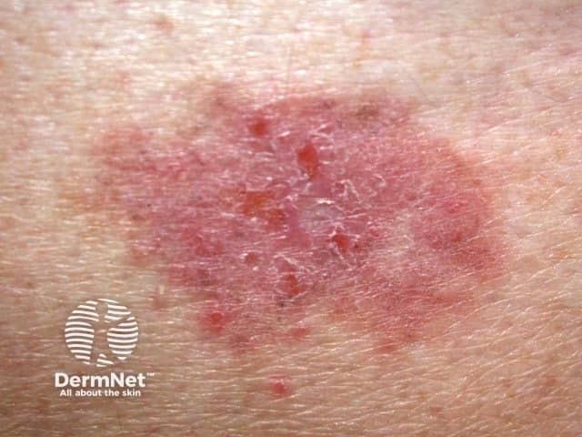 Basal cell carcinoma, leg