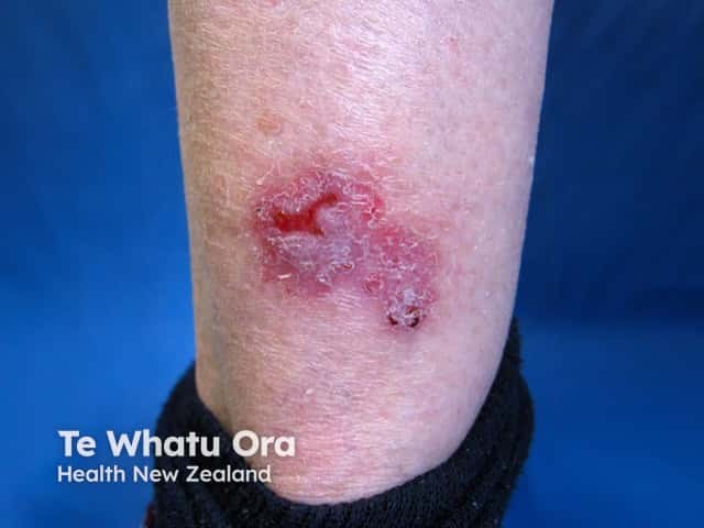 Basal cell carcinoma, leg