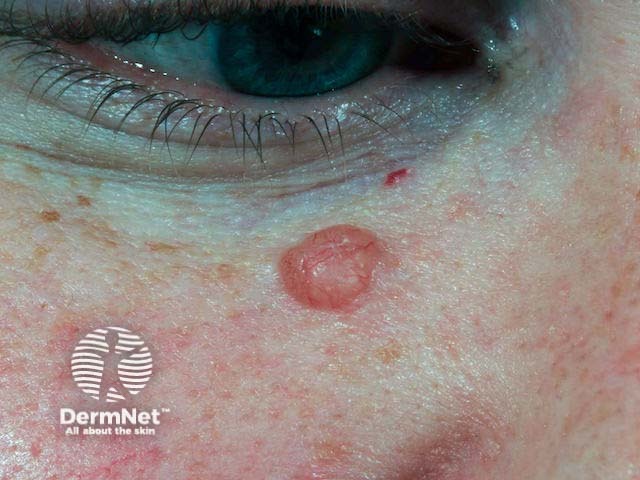 Nodular basal cell carcinoma