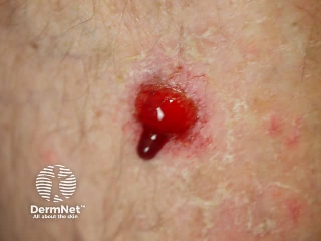 Bleeding basal cell carcinoma