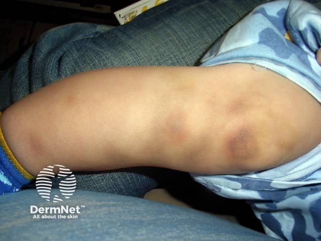 Bruises due to haemophilia