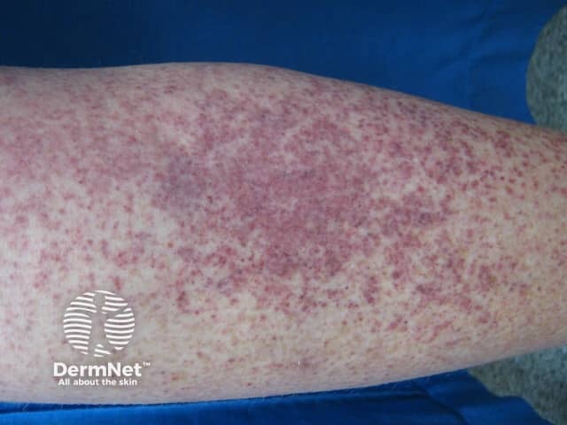 Petechiae due to thrombocytopaenia