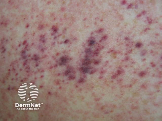 Petechiae due to thrombocytopaenia