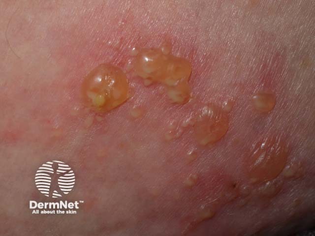 Bullous pemphigoid