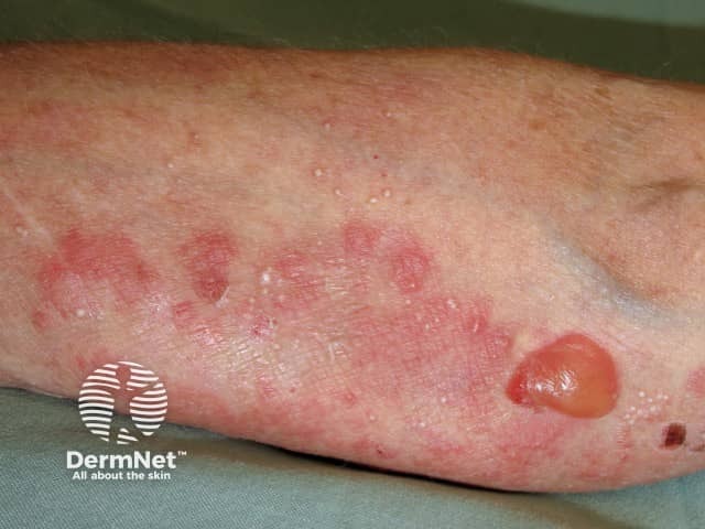 Bullous pemphigoid