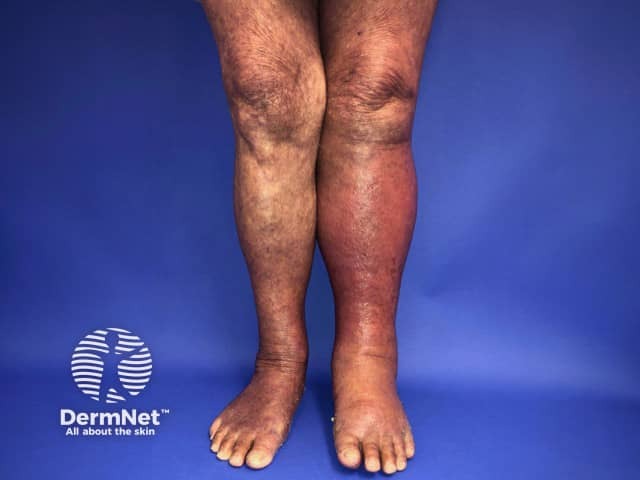 Cellulitis of the left leg