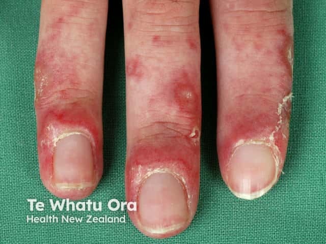 Lupus chilblains