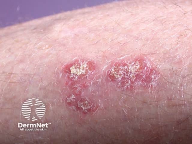 Chronic plaque psoriasis