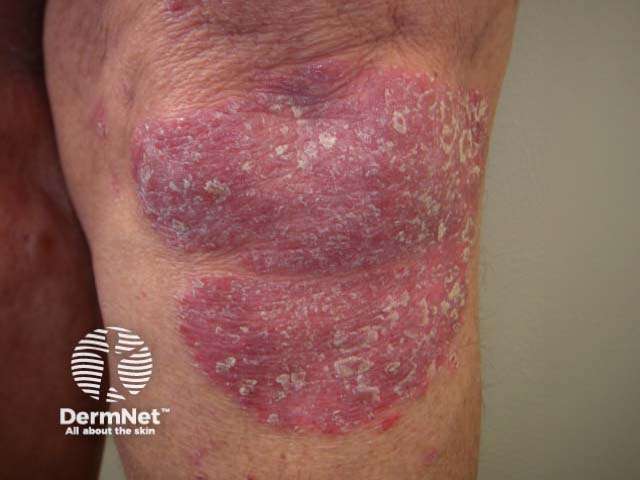 Chronic plaque psoriasis