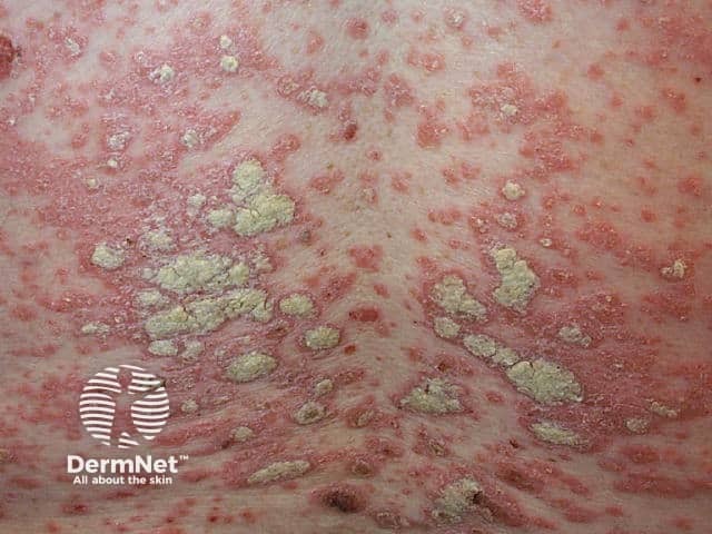 Chronic plaque psoriasis