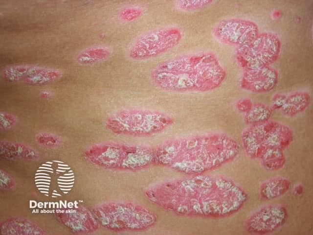 Chronic plaque psoriasis