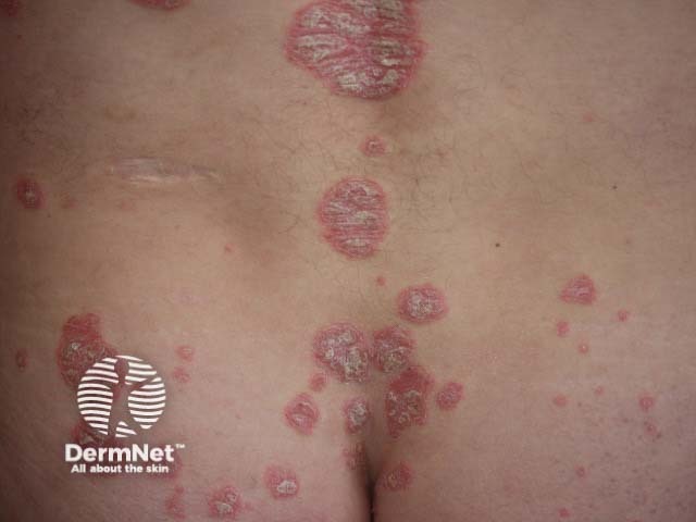 Chronic plaque psoriasis