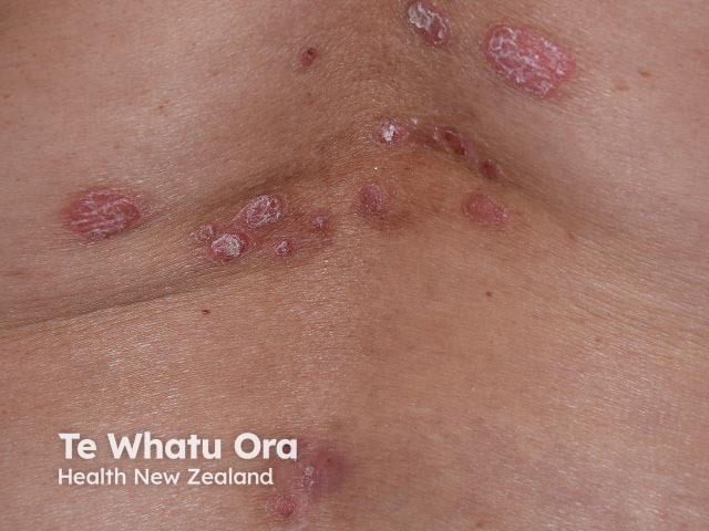 Chronic plaque psoriasis