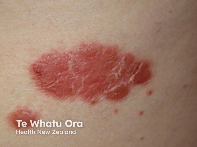 Chronic plaque psoriasis