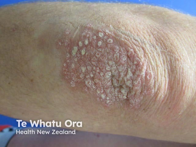 Chronic plaque psoriasis