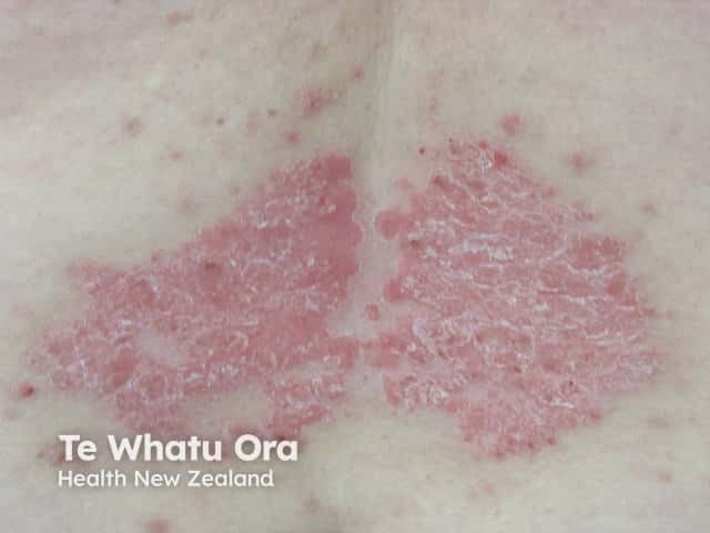 Chronic plaque psoriasis