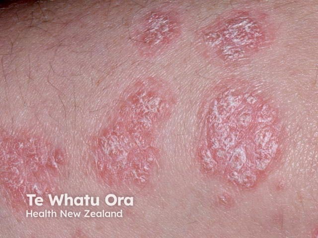 Chronic plaque psoriasis