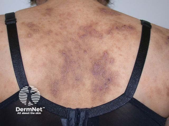 Chronic dermatitis