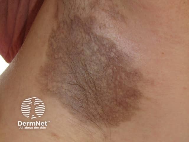 Erythema dyschromicum perstans