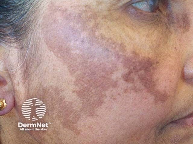 Melasma