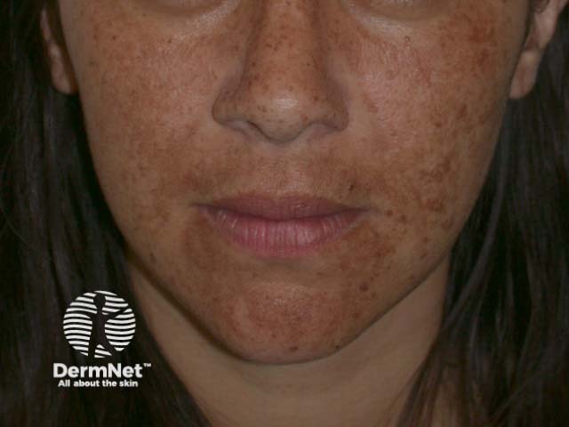 Melasma