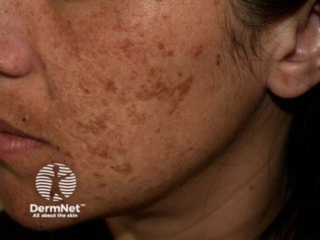 Melasma