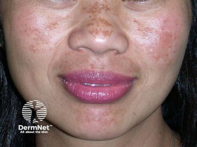 Melasma