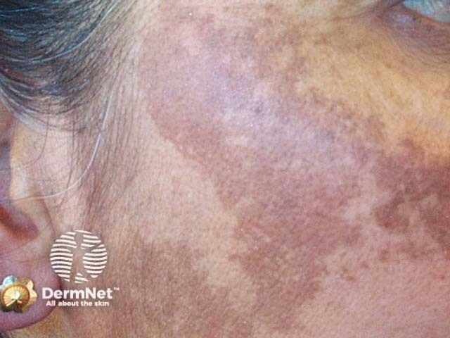 Melasma