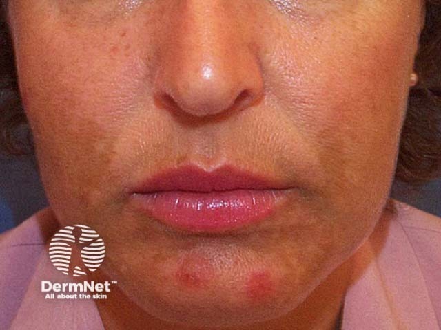 Melasma