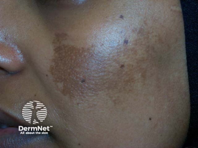 Melasma