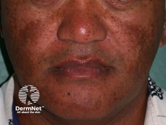 Melasma