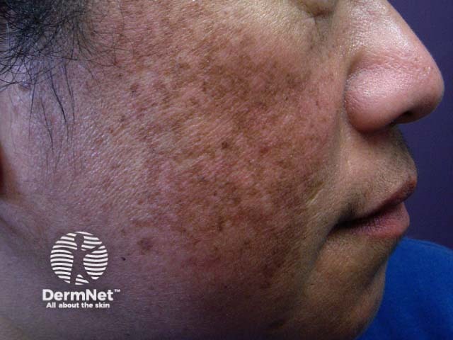 Melasma