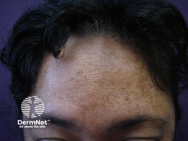 Melasma