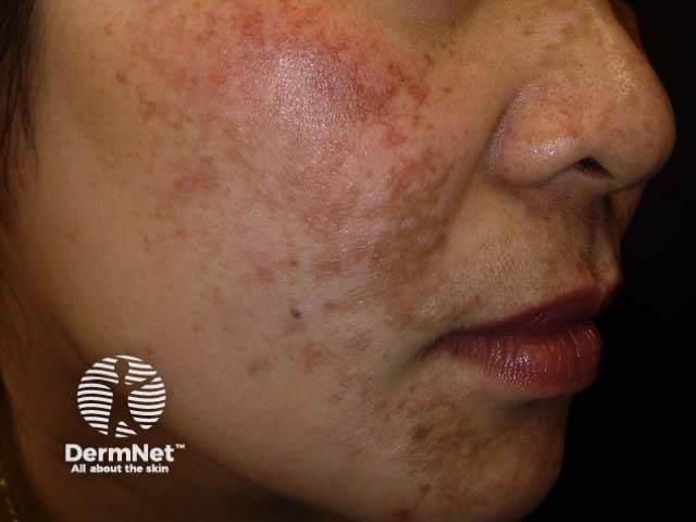 Melasma