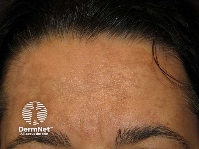 Melasma