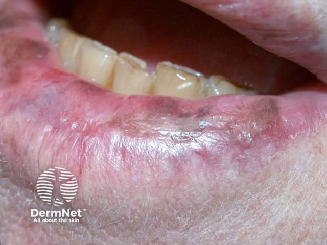 Lichen planus pigmentosus of lower lip