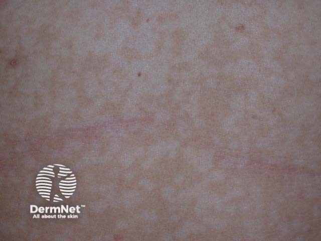 Pityriasis versicolor