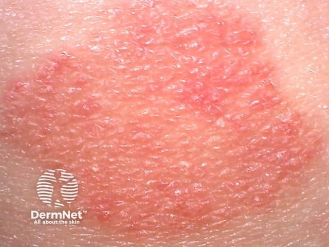 Red patch of psoriasis