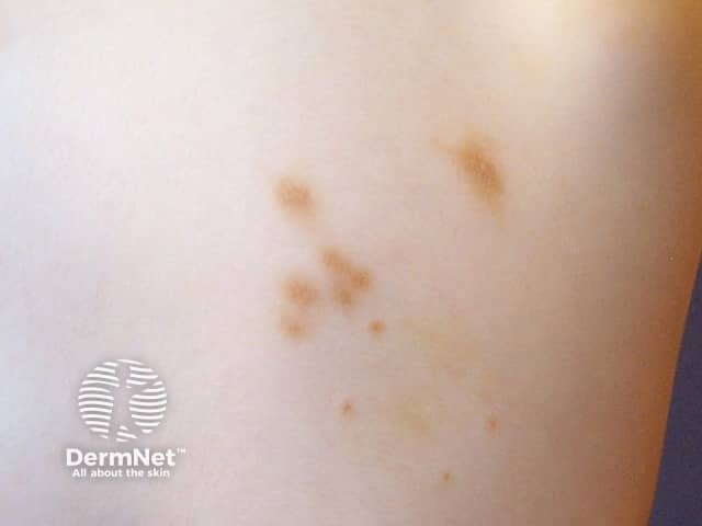 Urticaria pigmentosa in a child