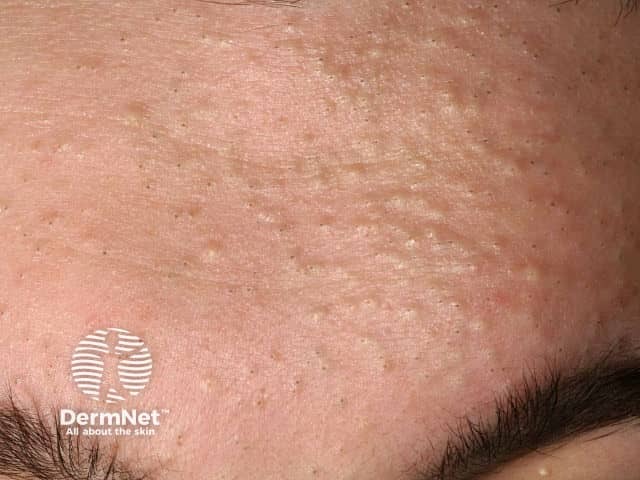 Comedonal acne