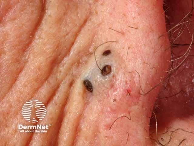 Multiheaded comedo cyst